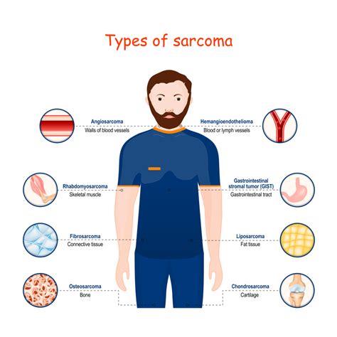 the lump tested as soft tissue hemangiosarcoma|Soft Tissue Sarcoma Diagnosis .